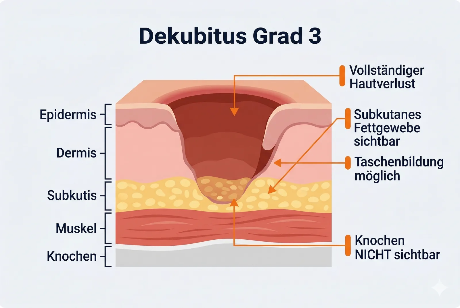 Dekubitus Grad 3: Tiefes Geschwür bis ins Fettgewebe im Querschnitt