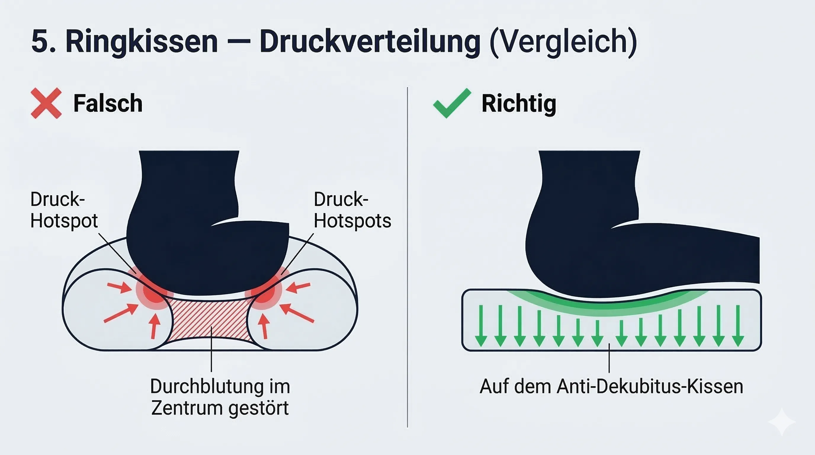 Ringkissen vs. flaches Kissen: Druckverteilung im Vergleich — Ringkissen erzeugt schädlichen Randdruck