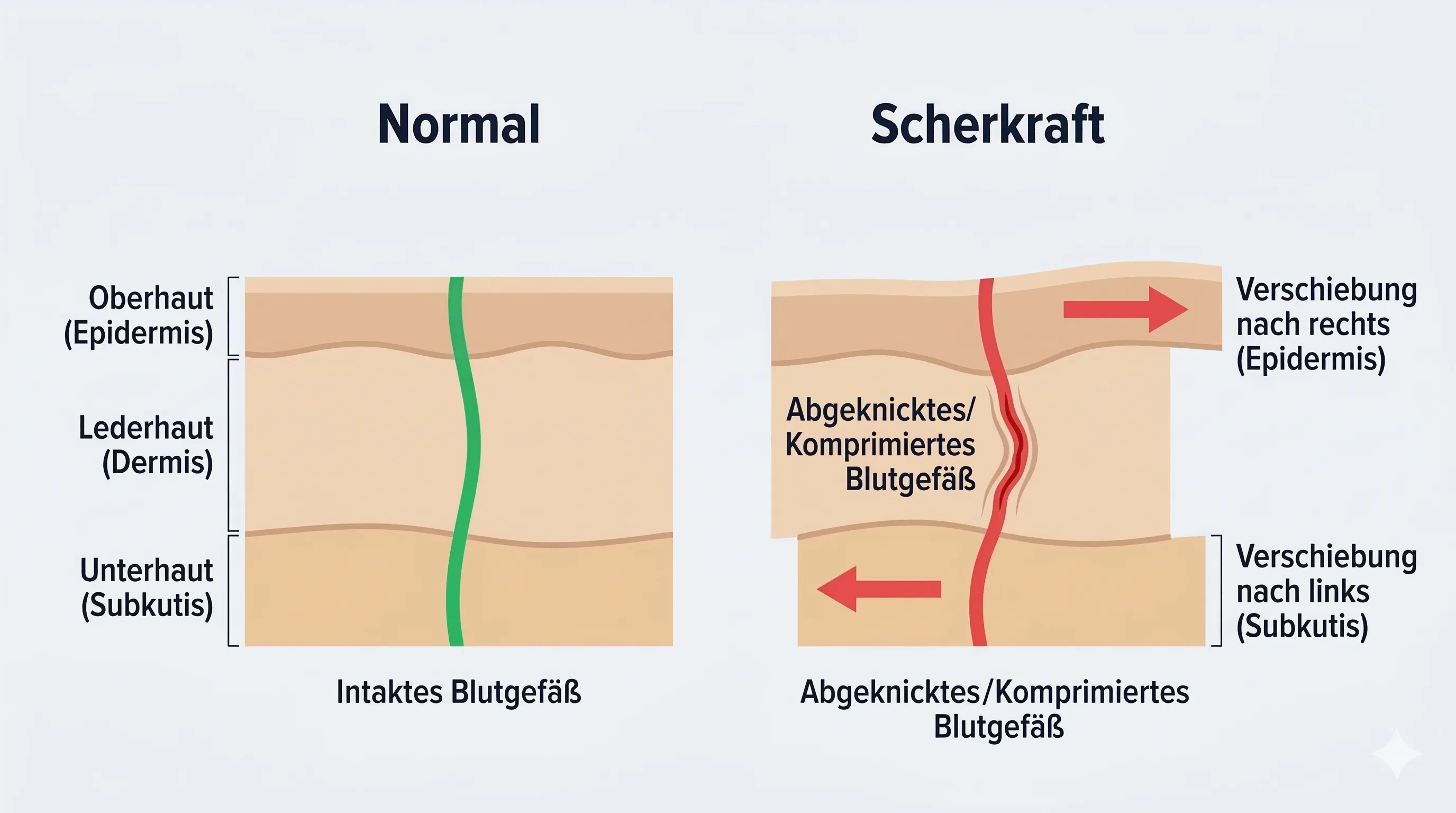 Scherkräfte bei Dekubitus: Hautschichten werden gegeneinander verschoben, Blutgefäße knicken ab