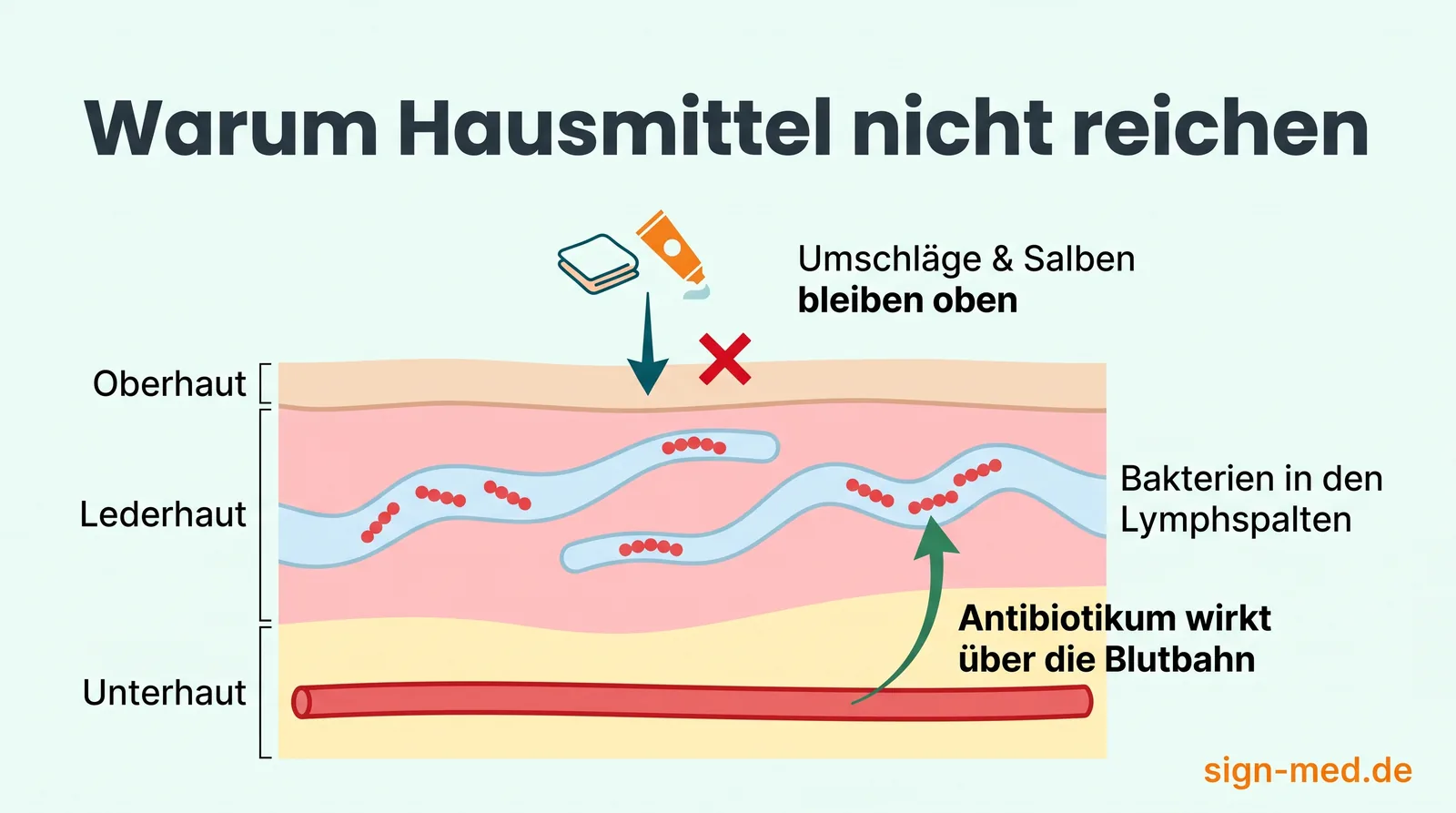 Hautquerschnitt-Grafik: Streptokokken sitzen in den Lymphspalten der Lederhaut — Umschläge und Salben bleiben an der Hautoberfläche, das Antibiotikum erreicht die Bakterien über die Blutbahn
